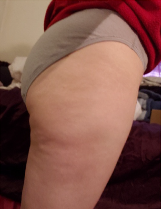 Close-up of thigh before using BodyBlendz anti-cellulite lotion showing visible cellulite and uneven skin texture prior to firming and smoothing treatment