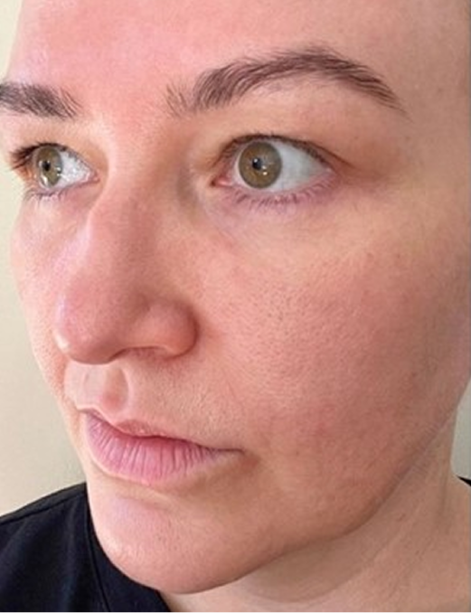 Side profile before using BodyBlendz lash and brow serum showing natural eyebrows and lashes with less fullness and definition prior to growth and enhancement