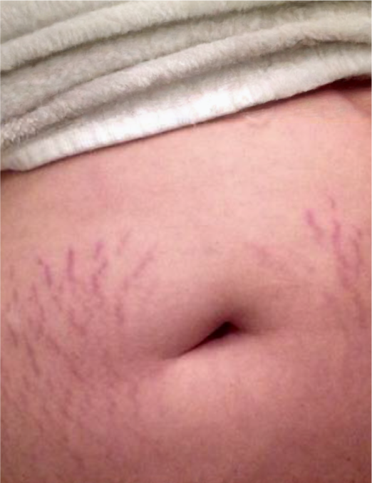 Close-up of abdomen with visible stretch marks before skincare treatment, showing uneven skin texture and purple stretch marks prior to using BodyBlendz body care products