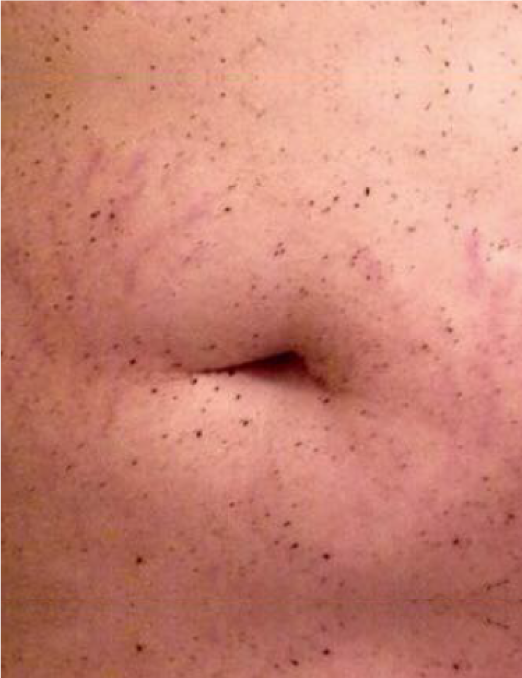 Close-up of skin after exfoliation showing reduced appearance of strawberry legs, smoother texture and minimized dark pores on body skin with BodyBlendz skincare results